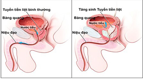 Điều trị tăng sinh tuyến tiền liệt lành tính (BPH)